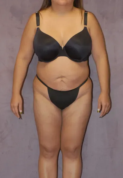 Mommy Makeover Before & After