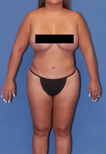 Mommy Makeover Before & After