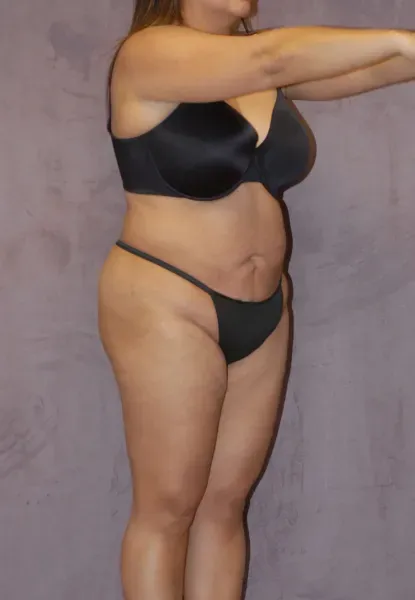 Mommy Makeover Before & After