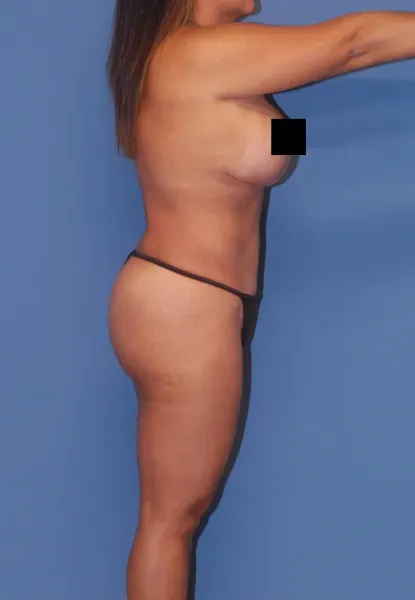 Mommy Makeover Before & After