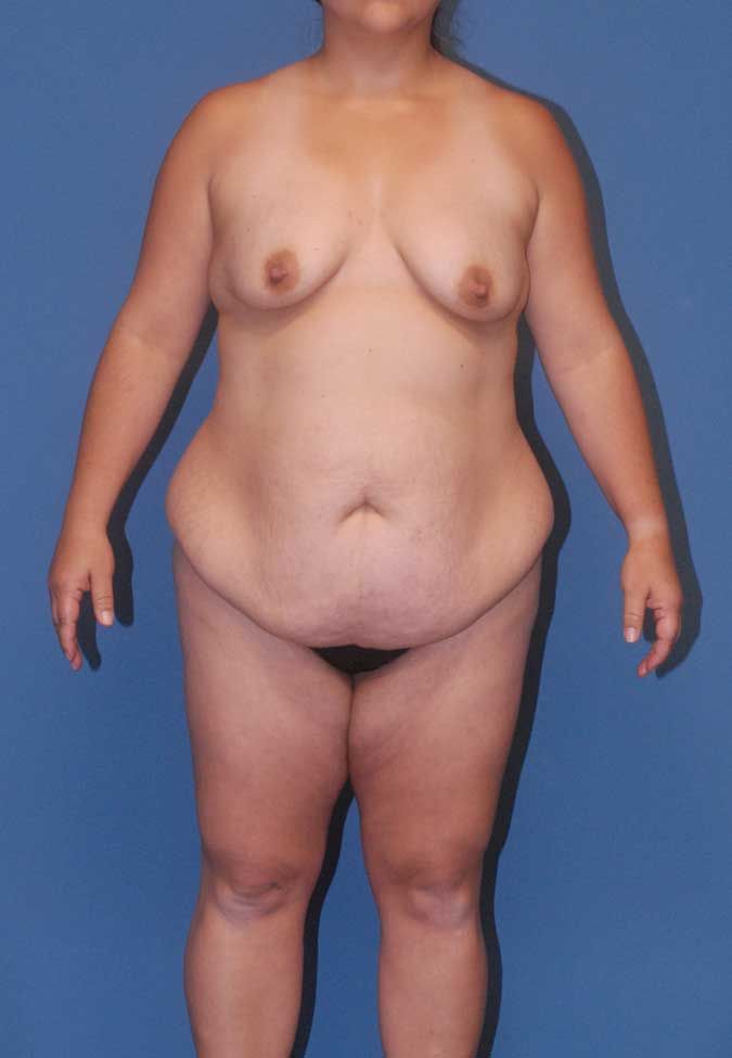 Mommy Makeover Before & After