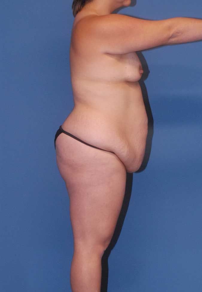 Mommy Makeover Before & After