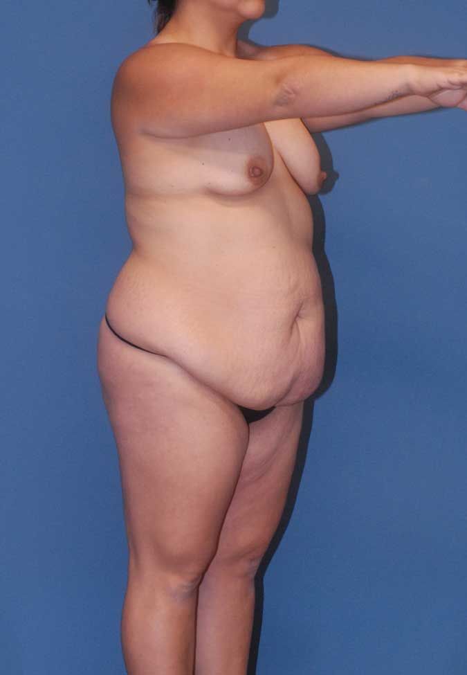 Mommy Makeover Before & After