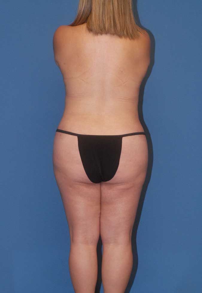 Mommy Makeover Before & After