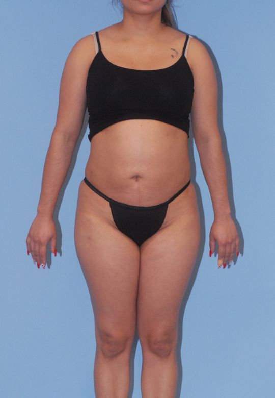 Mommy Makeover Before & After