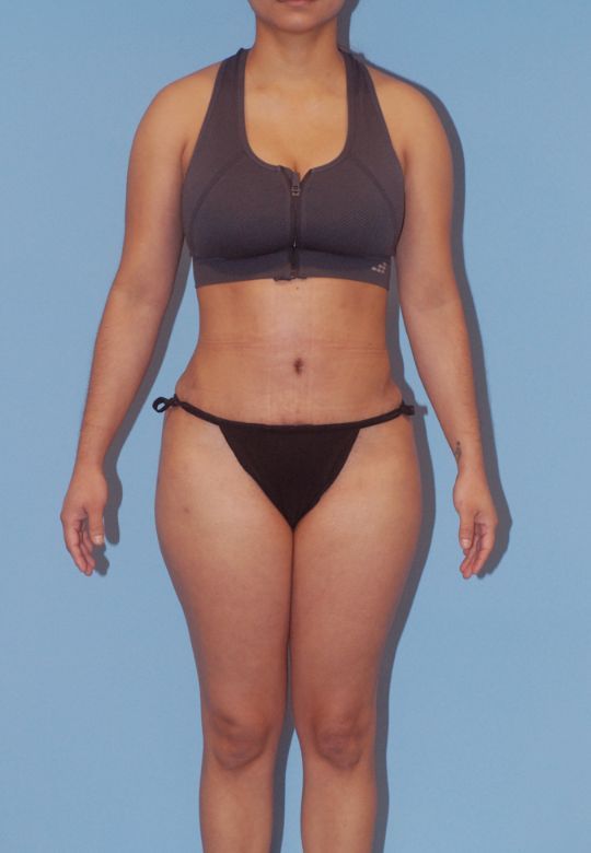 Mommy Makeover Before & After