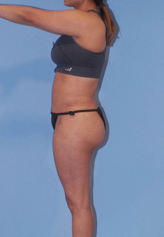 Mommy Makeover Before & After