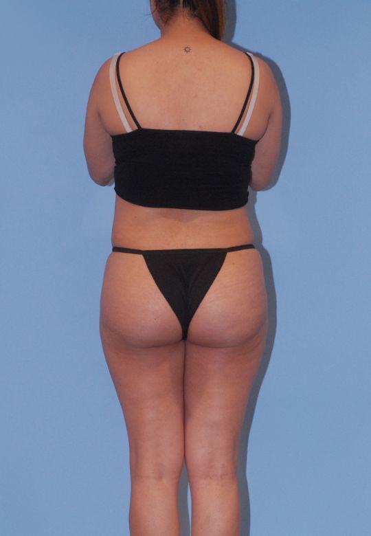 Mommy Makeover Before & After