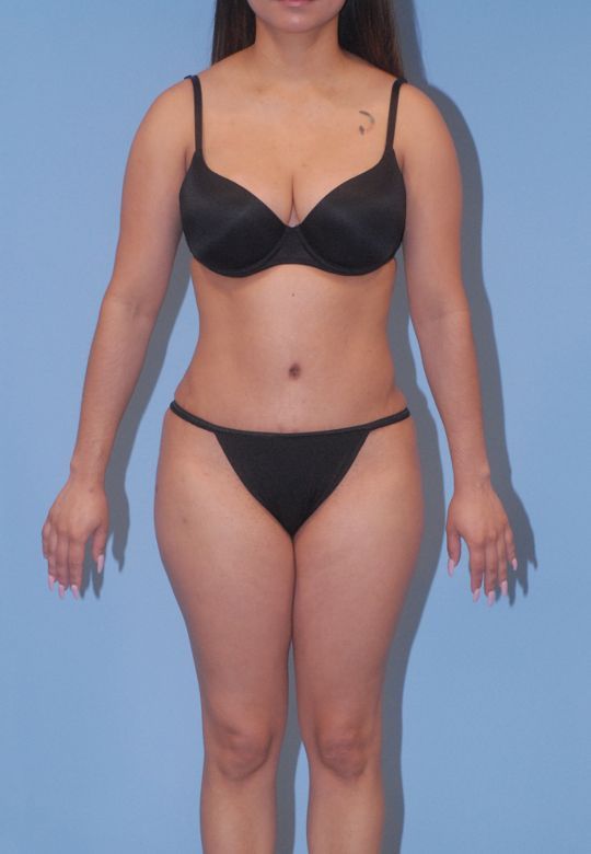 Mommy Makeover Before & After