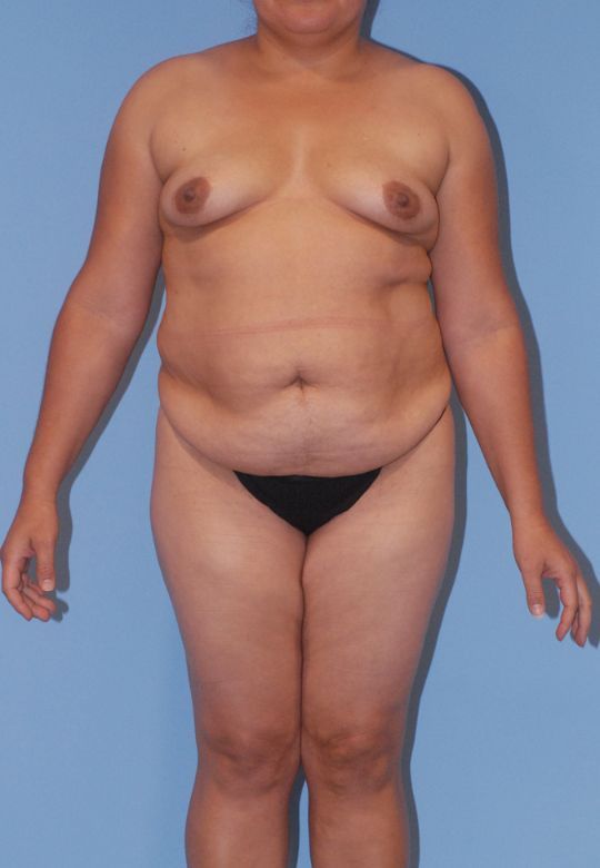 Mommy Makeover Before & After