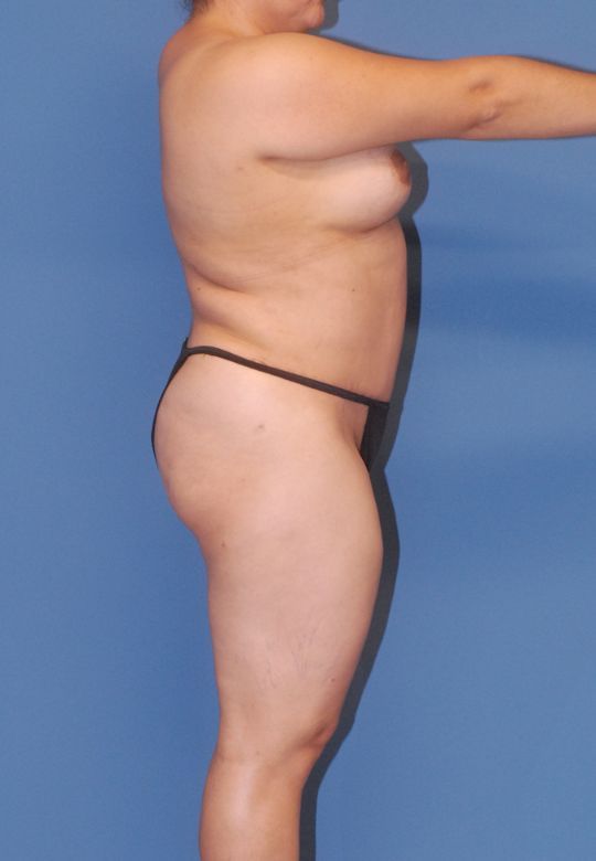 Mommy Makeover Before & After