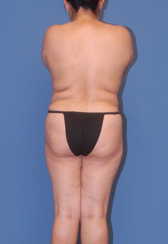 Mommy Makeover Before & After