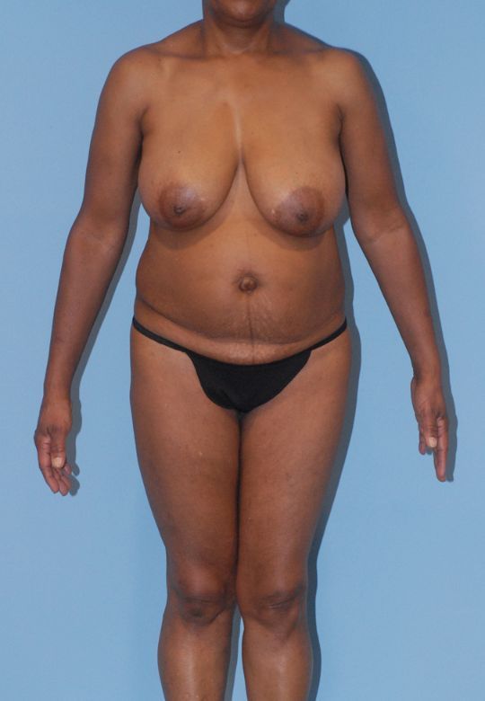 Mommy Makeover Before & After