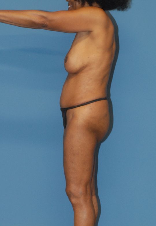 Mommy Makeover Before & After