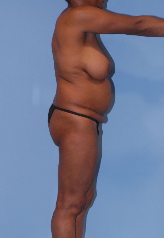 Mommy Makeover Before & After