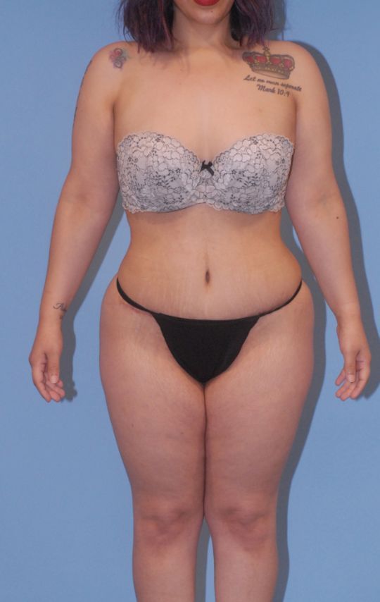 Mommy Makeover Before & After