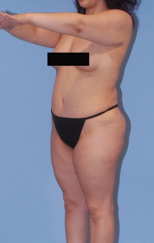 Mommy Makeover Before & After