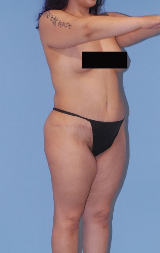 Mommy Makeover Before & After