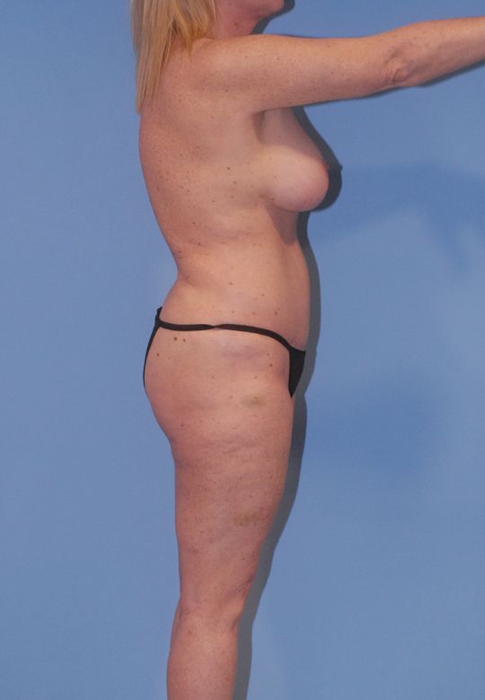 Mommy Makeover Before & After