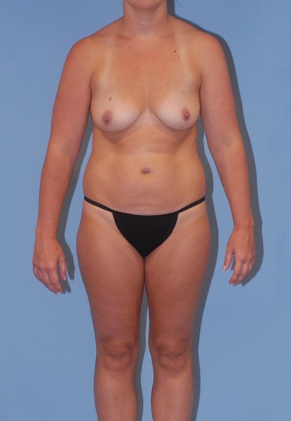 Mommy Makeover Before & After