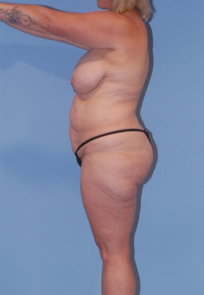 Mommy Makeover Before & After