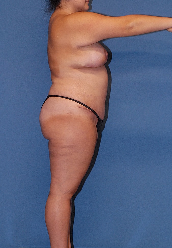 Mommy Makeover Before & After