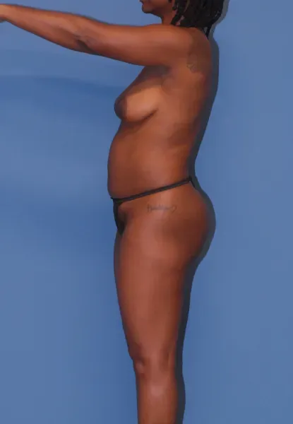 Mommy Makeover Before & After