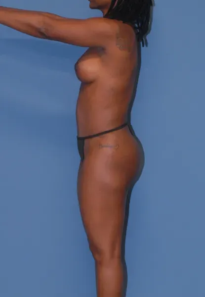 Mommy Makeover Before & After