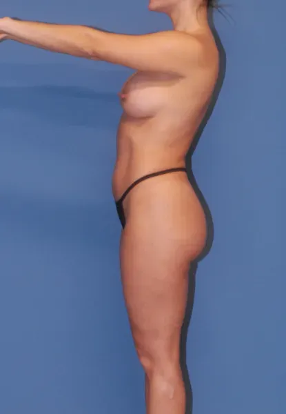 Mommy Makeover Before & After