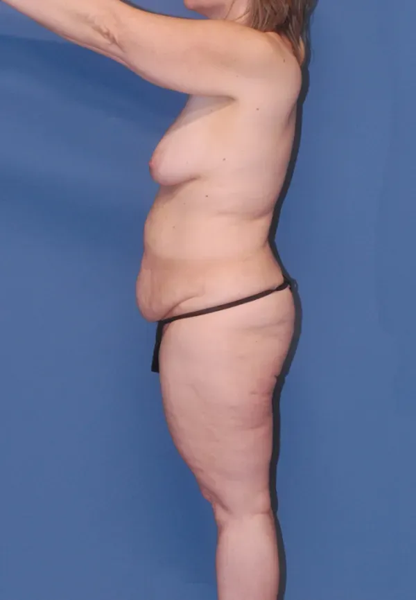 Mommy Makeover Before & After