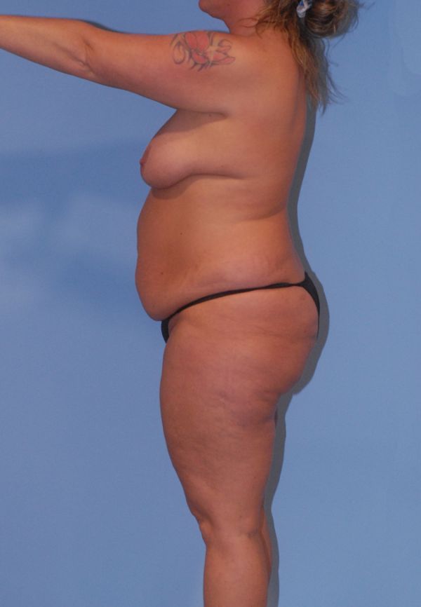 Mommy Makeover Before & After