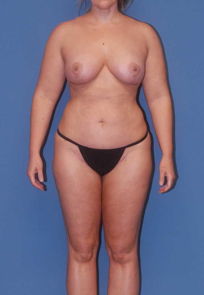 Mommy Makeover Before & After