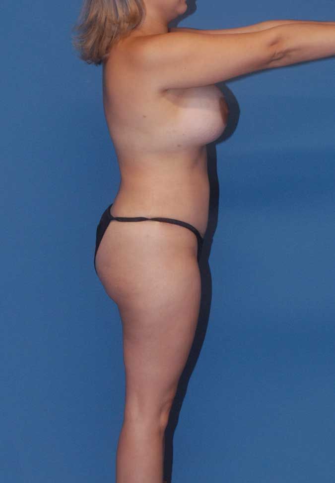 Mommy Makeover Before & After