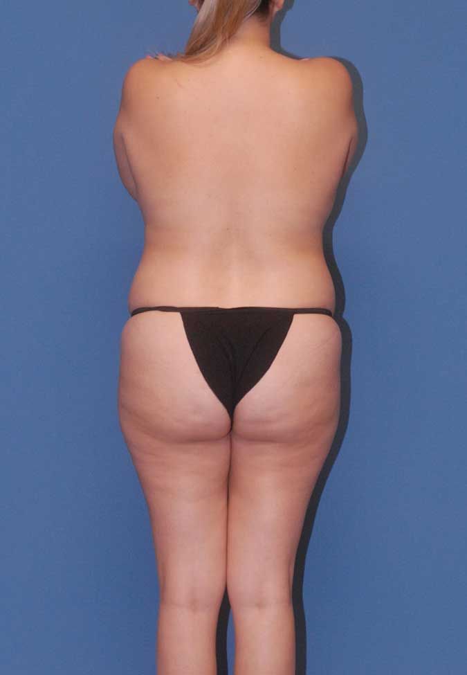 Mommy Makeover Before & After