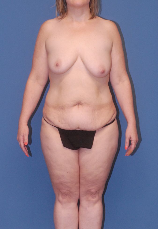 Mommy Makeover Before & After