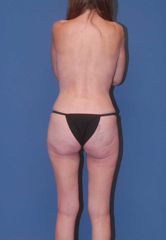 Mommy Makeover Before & After