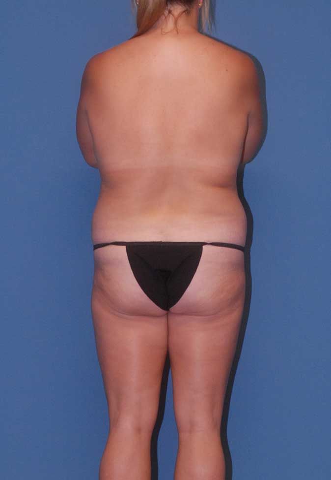 Mommy Makeover Before & After