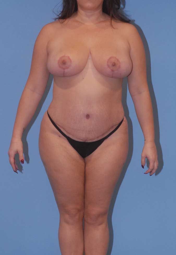 Mommy Makeover Before & After