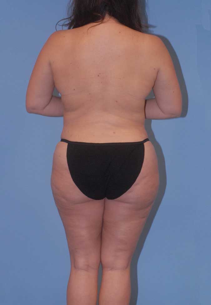 Mommy Makeover Before & After