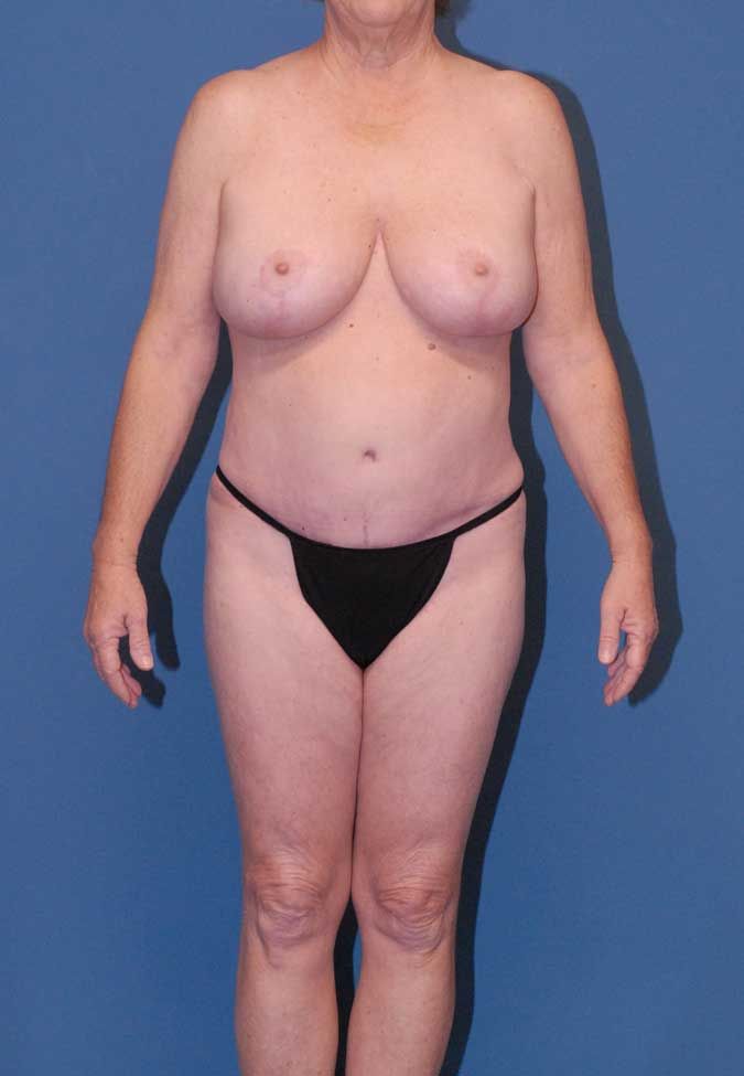 Mommy Makeover Before & After