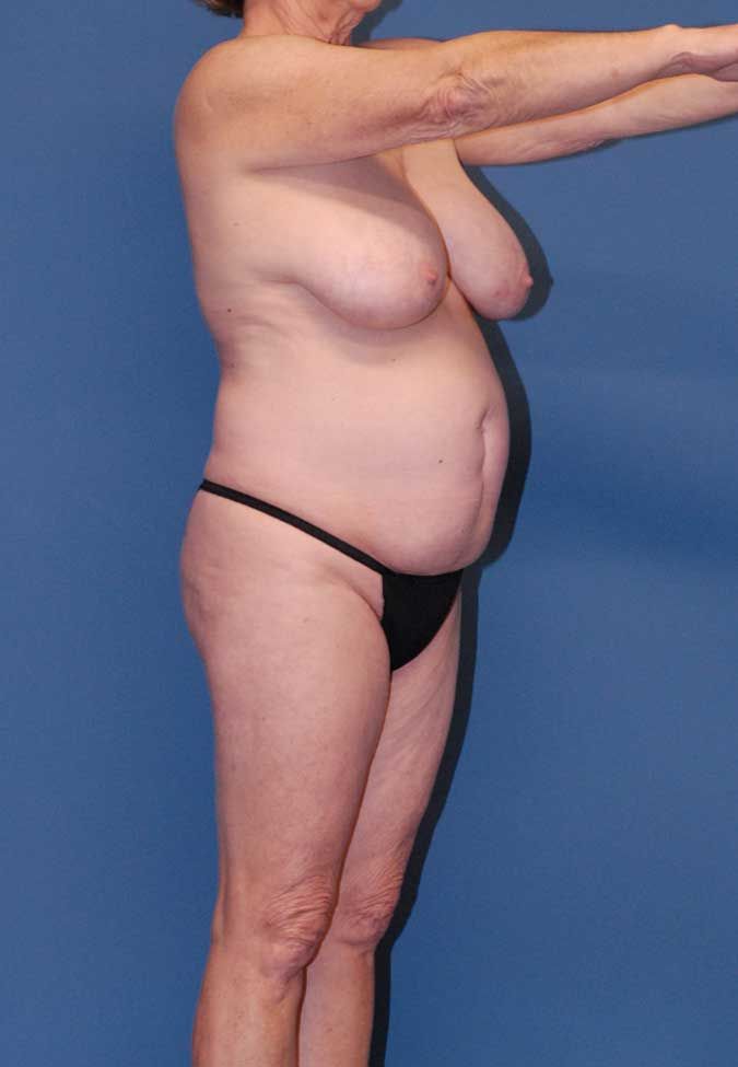 Mommy Makeover Before & After