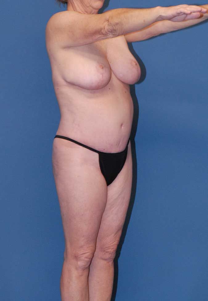 Mommy Makeover Before & After