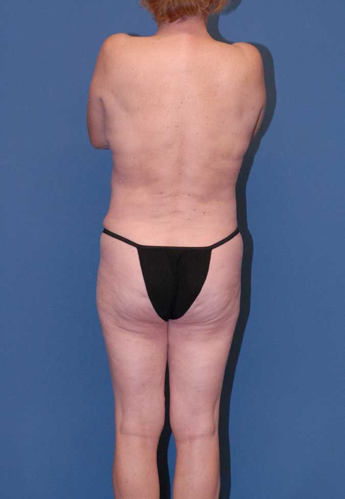 Mommy Makeover Before & After