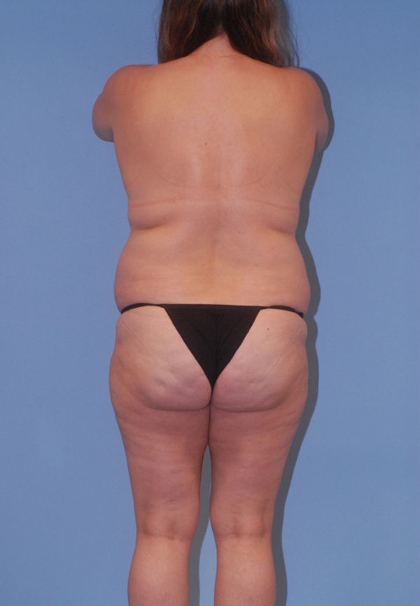 Mommy Makeover Before & After