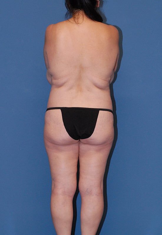 Mommy Makeover Before & After