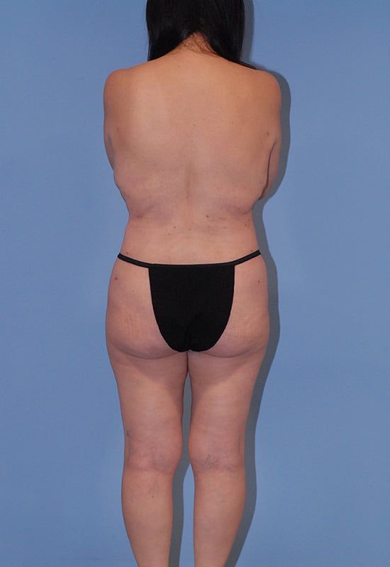 Mommy Makeover Before & After