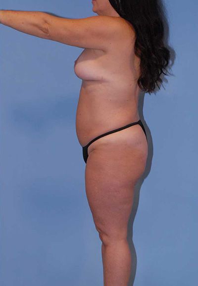 Mommy Makeover Before & After