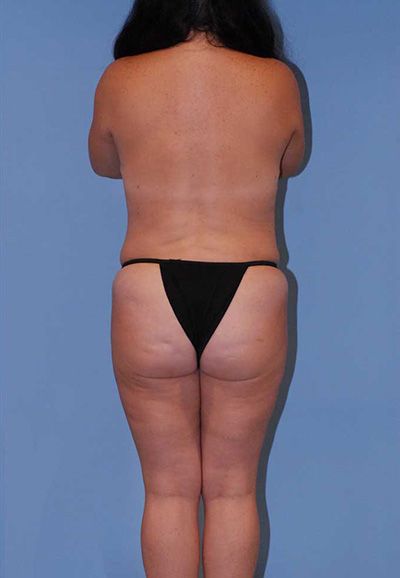 Mommy Makeover Before & After