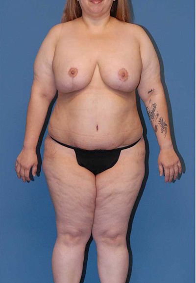 Mommy Makeover Before & After