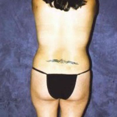 Liposuction Before & After